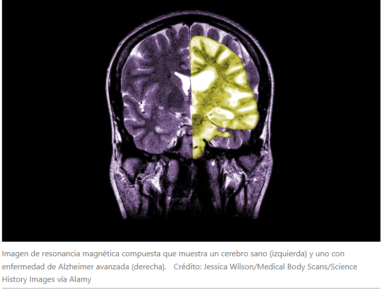 Debate sobre el fármaco contra el Alzheimer, lecanemab, mientras el Reino Unido limita su aprobación